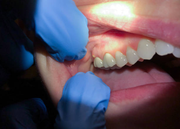 Best Emergency Tooth Extraction in Lowell, MA